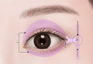 확실하고 견고한 고정! 다시 붙는 유착현상 방지