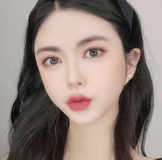 눈매교정 수술 후