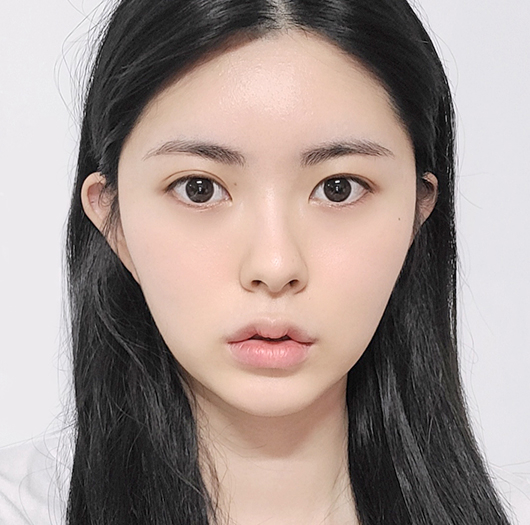 눈매교정 수술 전