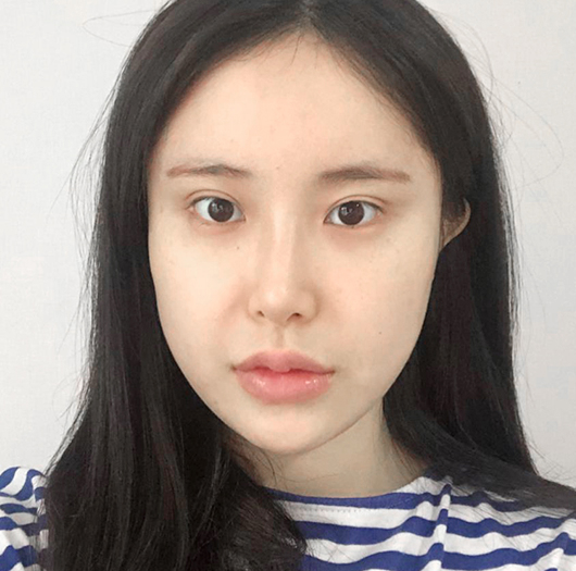 눈매교정 수술 전