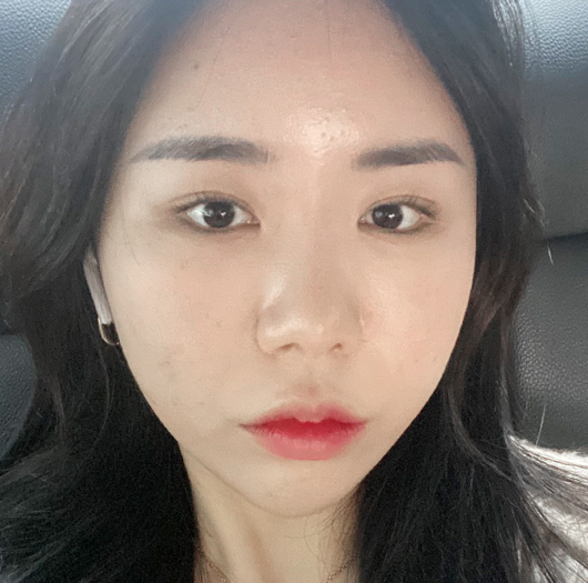 눈매교정 수술 전