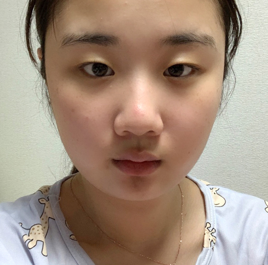 눈매교정 수술 전