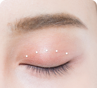 비절개 눈매교정