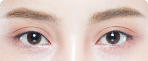 쌍꺼풀 높이가 높은 경우