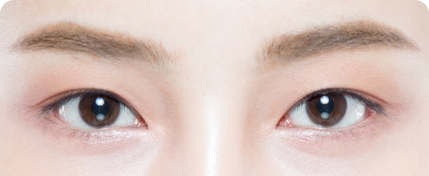 쌍꺼풀이 얕은 경우