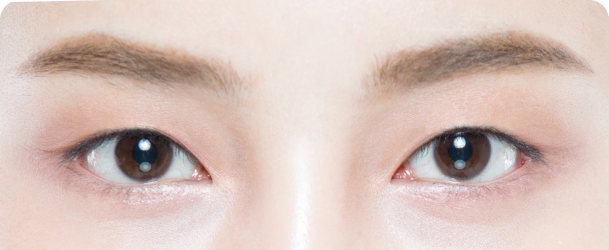 쌍꺼풀이 풀린 경우