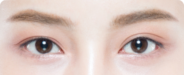 쌍꺼풀이 좌우 비대칭인 경우