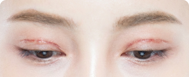 쌍꺼풀 흉터가 심한 경우