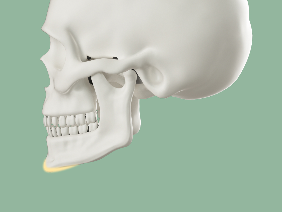 어떤 각도에도 슬림해보이는 무턱·짧은 턱 V라인 교정