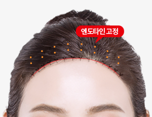이마축소 수술방법 4