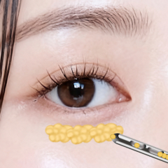 앞광대 지방이식